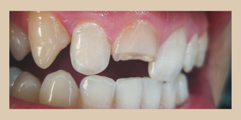 Dentista Bergamo denti rotti scheggiati Dr. Bernini Silvia