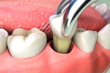 chirurgia ai denti Studio Ortodontico Dott.ssa Silvia Bernini Bergamo
